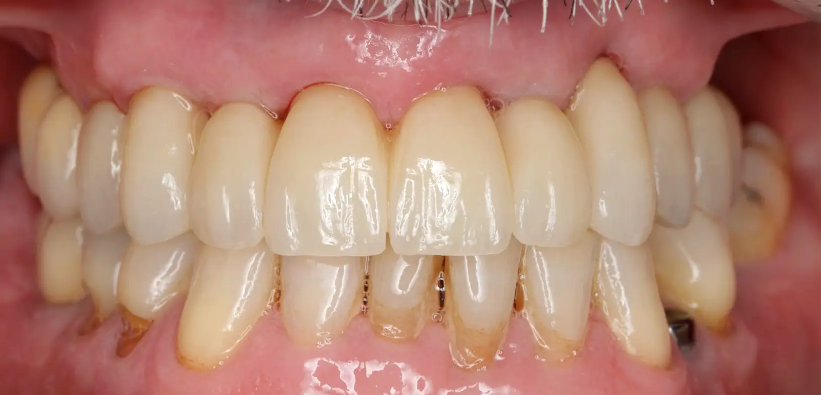 PATIENT POST Surgery - Dr Guillermo Escobar