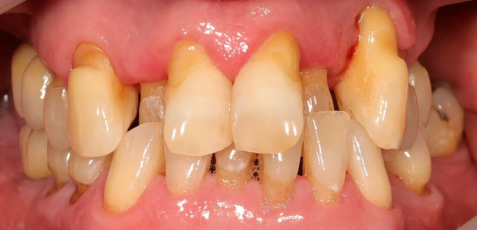 Patient PRE - Dr Guillermo Escobar