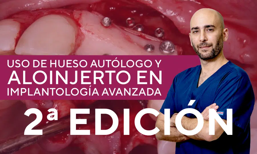 Curso Uso de Hueso Aut&oacute;logo y Aloinjerto en Implantolog&iacute;a Avanzada - 2&ordf; Edici&oacute;n del Dr. Guillermo Escobarn