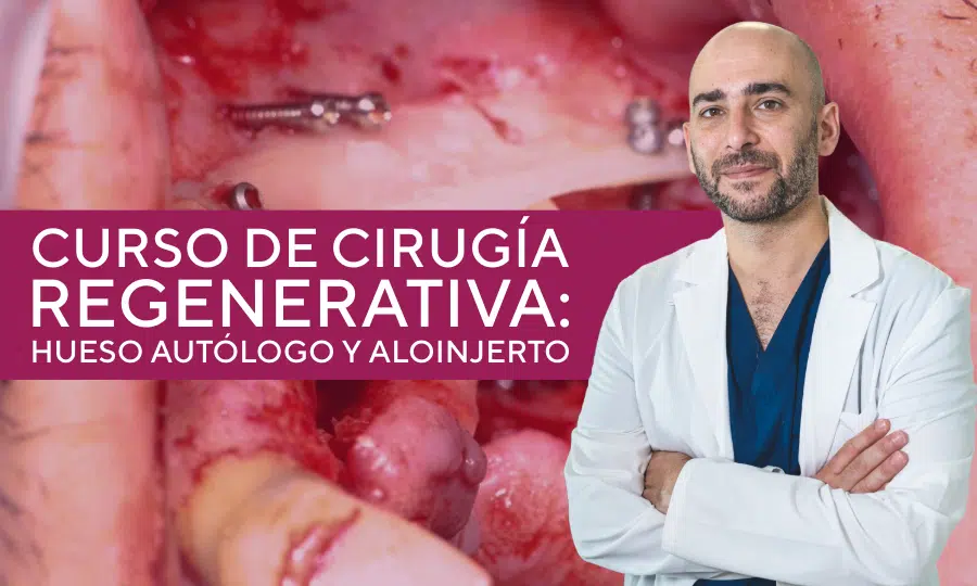 Curso de Cirug&iacute;a Regenerativa: Hueso Aut&oacute;logo y Aloinjerto del Dr. Escobar